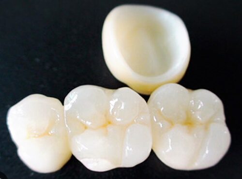 金属（メタル）を避けた治療